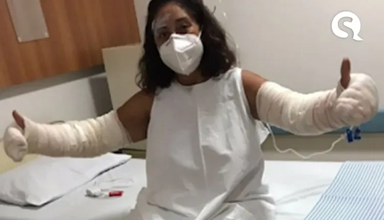 Mulher tem 40% do corpo queimado após desodorante explodir por descarte incorreto