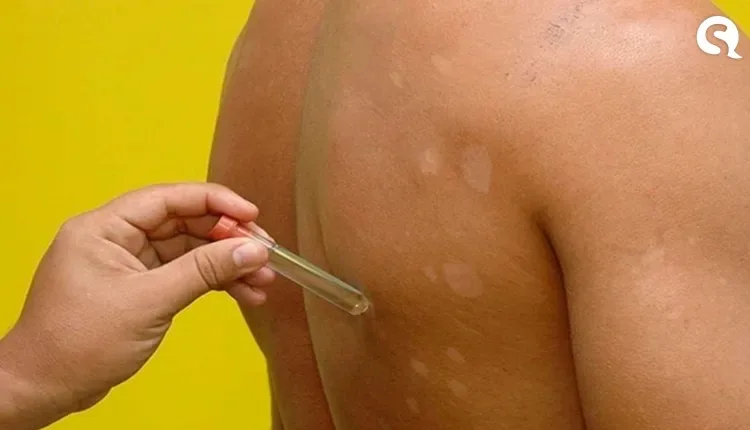 Desinformação e preconceito afastam pessoas com hanseníase de tratamento, oferecido gratuitamente pelo SUS