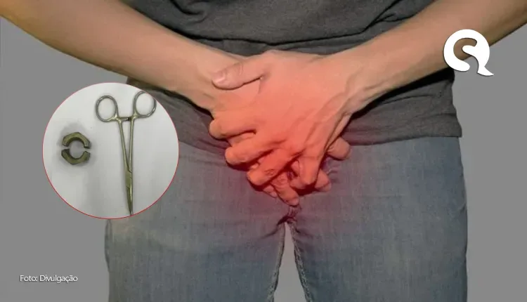 Homem tem pênis estrangulado por porca de 2 cm usada em masturbação