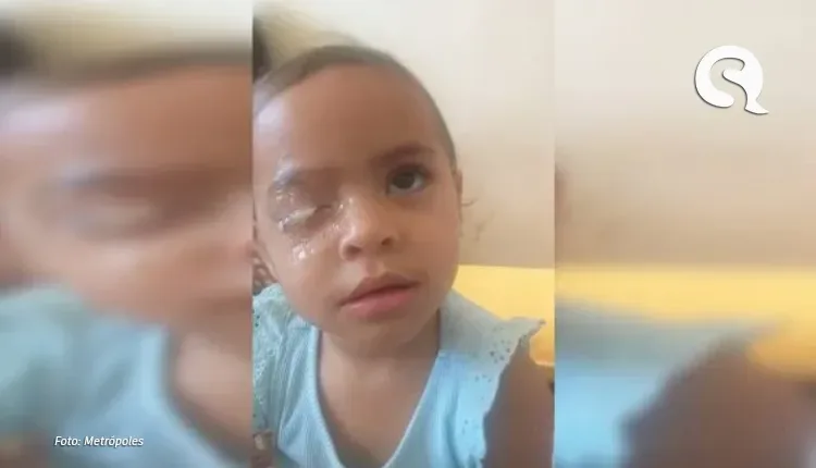 Menina passará por cirurgia após aplicar cola Super Bonder no olho