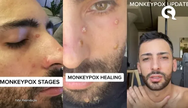 Jovem mostra sintomas de monkeypox no corpo em vídeos do TikTok