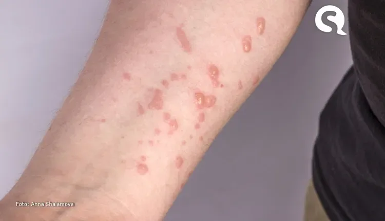 Santa Quitéria notifica primeiro caso suspeito de monkeypox