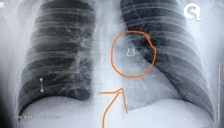 Piercing perdido há cinco anos é encontrado em pulmão de homem