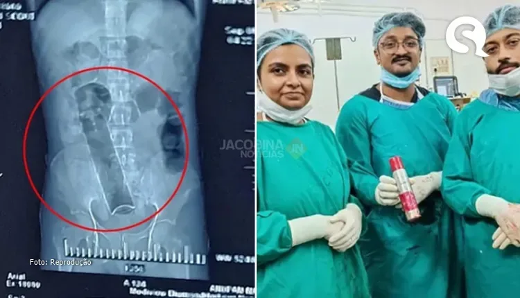 Homem passa por cirurgia de 2 horas para retirar desodorante do ânus