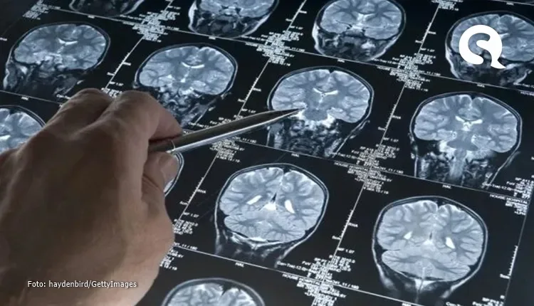 Alzheimer pode ser doença autoimune do cérebro, sugere pesquisador