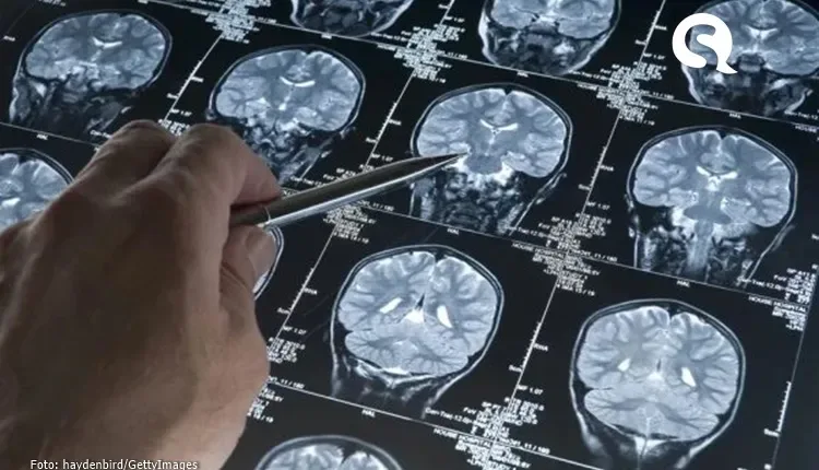 Estudo encontra biomarcadores inéditos para prever risco de Alzheimer