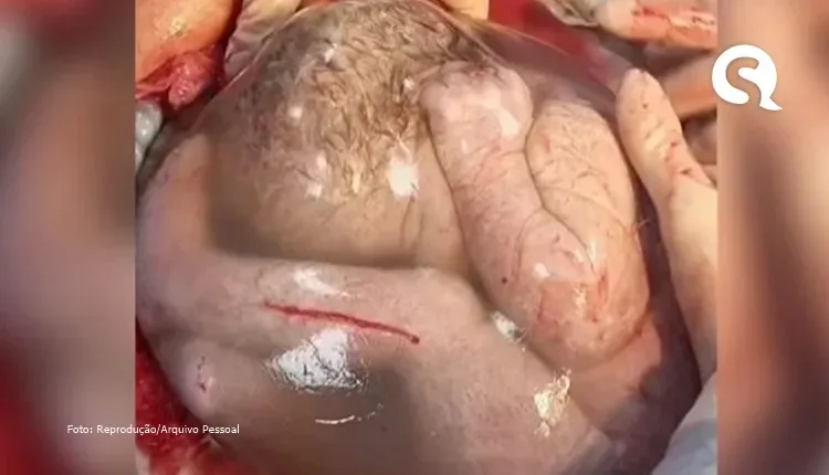 Médica compartilha vídeo em que gêmea nasce empelicada: “Mágico”