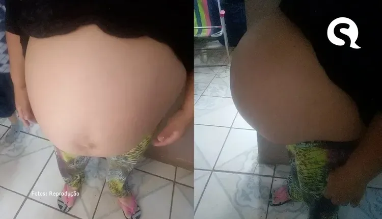 Pedido de aborto é negado, pelo STJ e STF, à grávida de gêmeas siamesas com má formação