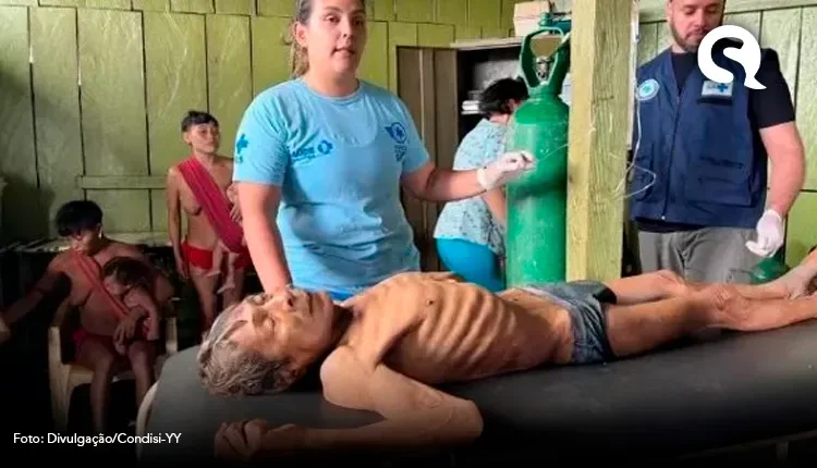 Ministério da Saúde declara estado de emergência em terras Yanomamis
