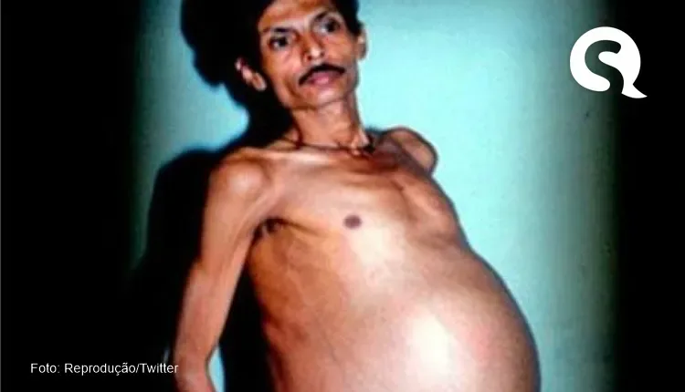 Indiano descobre feto de irmão gêmeo dentro do corpo há 36 anos