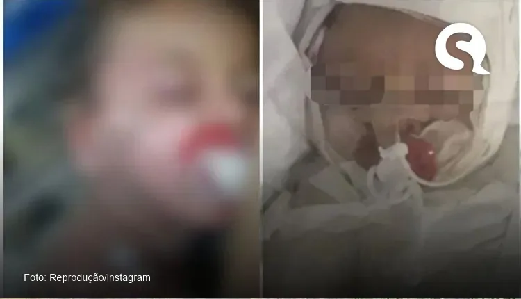 Bebê sofre queimaduras grave em Itapipoca e família pede ajuda nas redes sociais