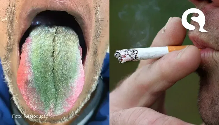 Homem tem reação e fica com a língua verde e peluda após fumar cigarro