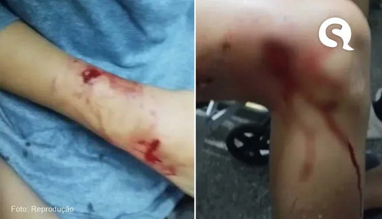 Garoto leva sete pontos após ser atacado por pitbull enquanto brincava, em Quixeramobim