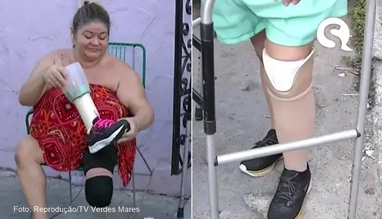 Mulher que usava liquidificador no lugar da perna amputada, em Sobral recebe prótese: ‘Reaprendendo a andar’