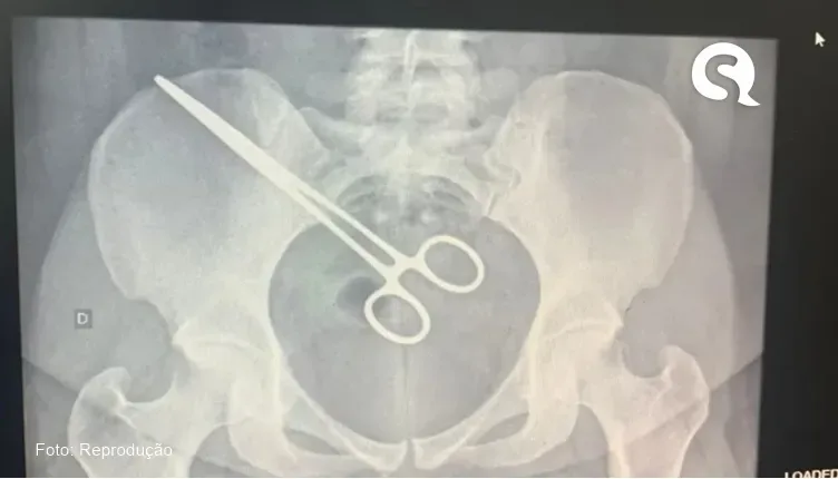 Mulher descobre pinça cirúrgica dentro do corpo ao visitar marido na cadeia