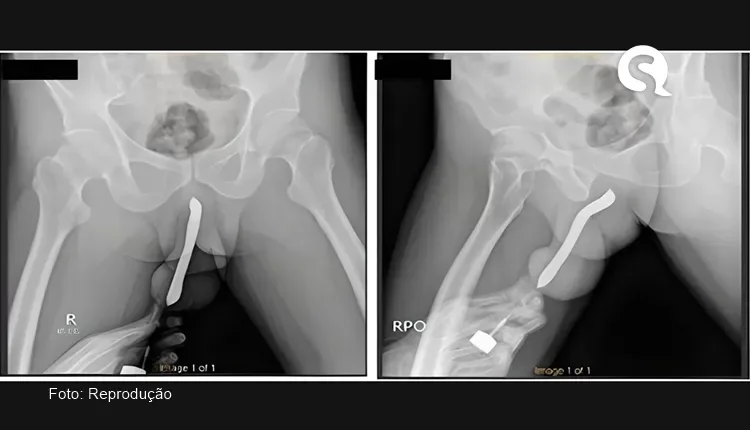Homem coloca escova de dentes no pênis e objeto quebra durante o sexo