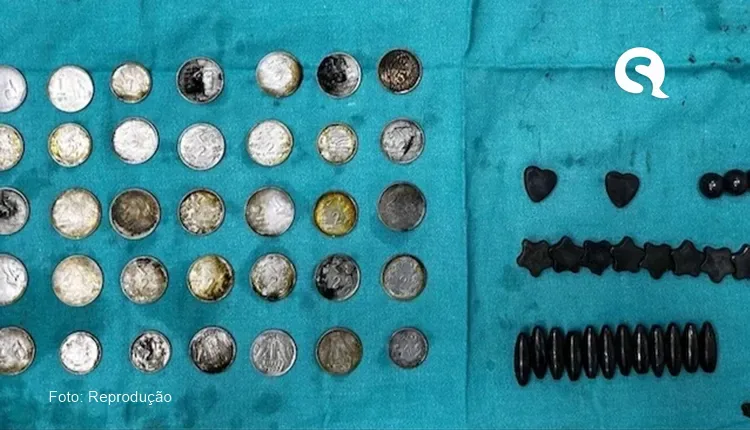 Homem engole 39 moedas e 37 ímãs acreditando que levantaria mais peso na academia