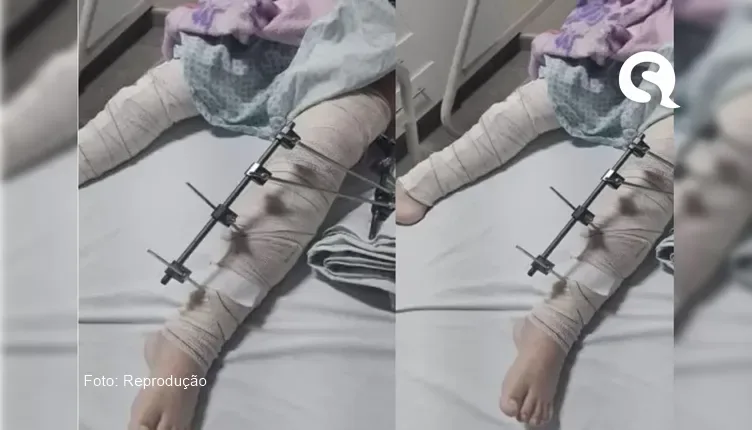 Menina de 6 anos é operada e tem pinos colocados na perna errada e gera confusão