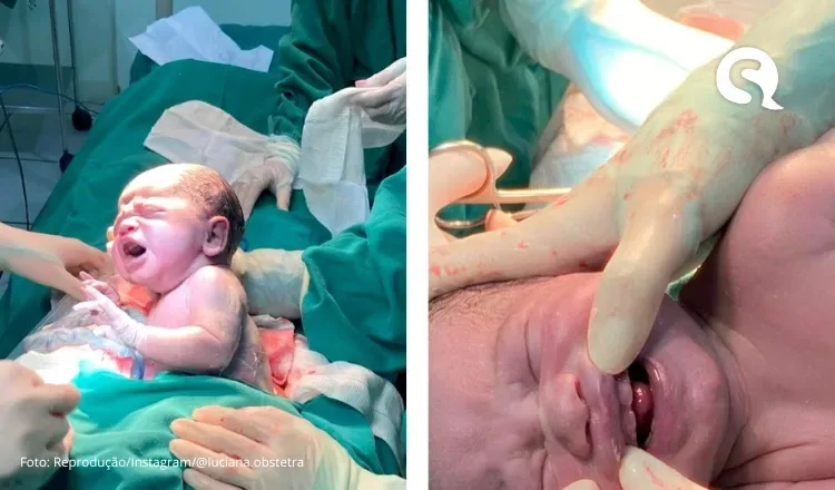 Bebê nasce com seis dentes e causa surpresa em médicos em MS; assista ao momento