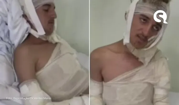 Jovem é queimado com óleo quente em ataque homofóbico no Ceará