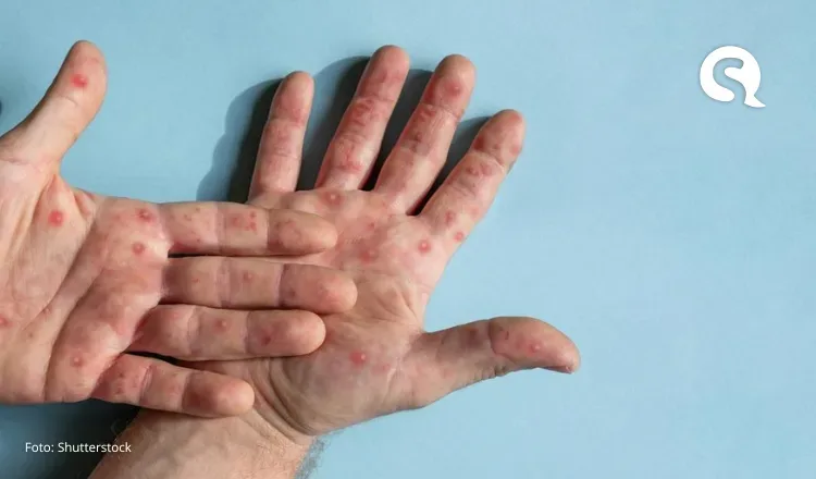 Ceará confirma 13 casos de Mpox; veja sintomas e como se prevenir