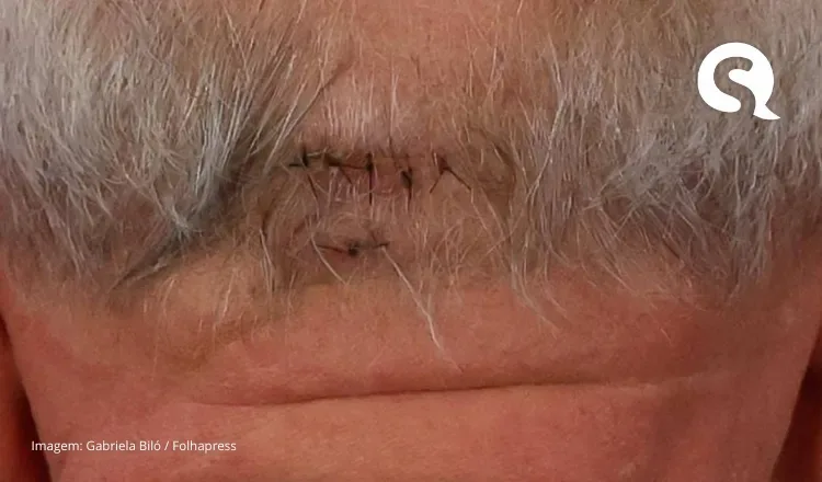 Lula ficará com dreno na cabeça por até três dias e terá vida normal após alta, diz médico