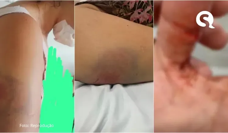 Mulher é atacada com mordidas pelo companheiro, tem queixo destruído e lábios arrancados, em Fortaleza; homem está preso