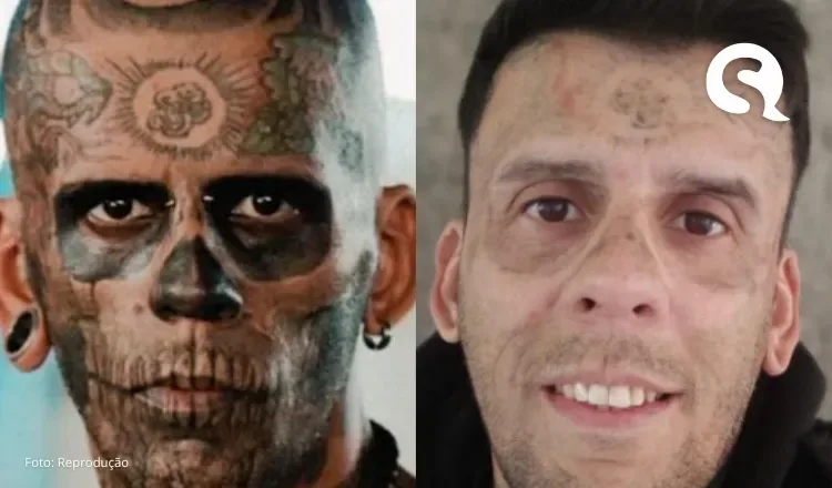 Homem que já foi o ‘mais tatuado do Brasil’ remove tatuagens no rosto